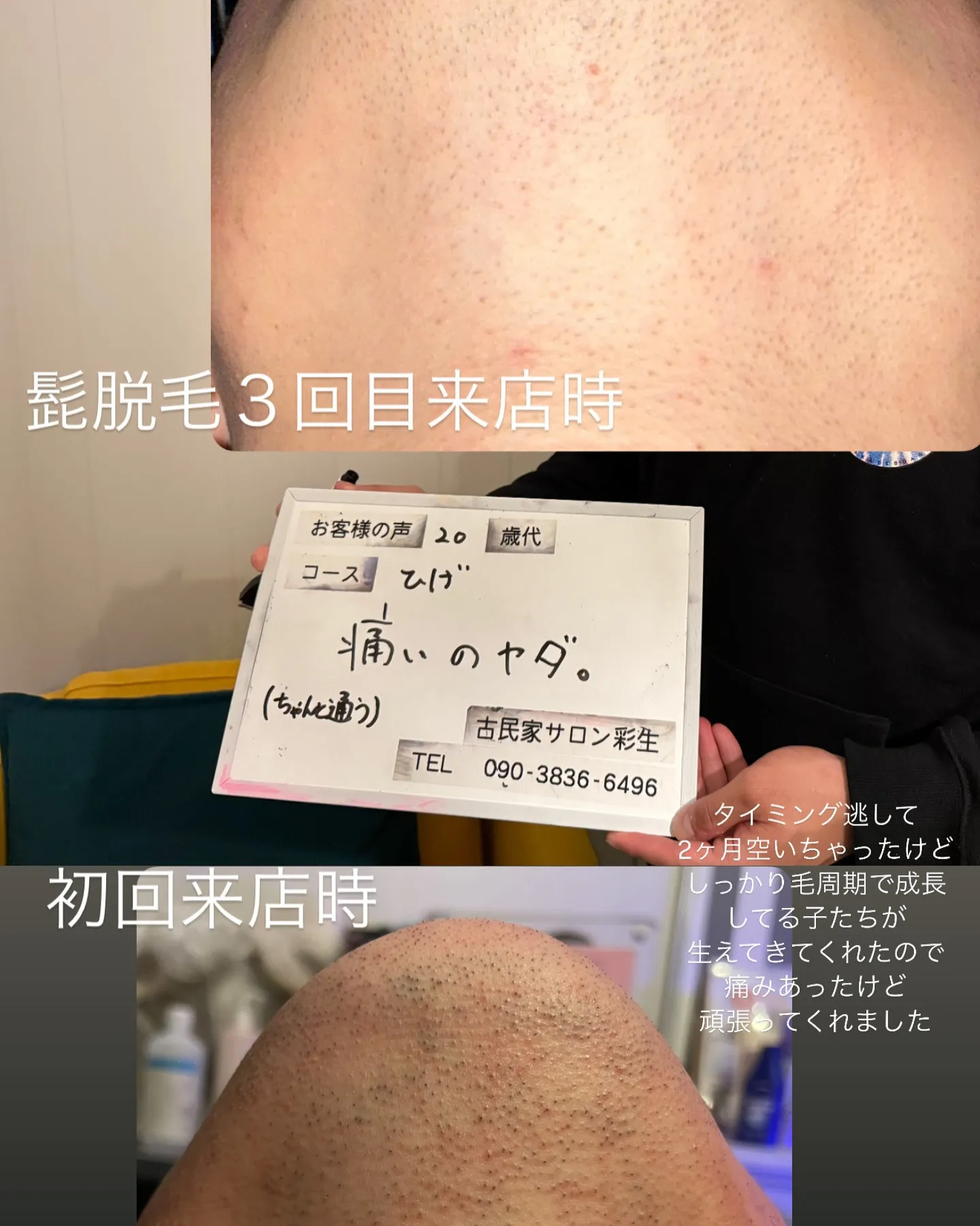 定期メンテの脱毛