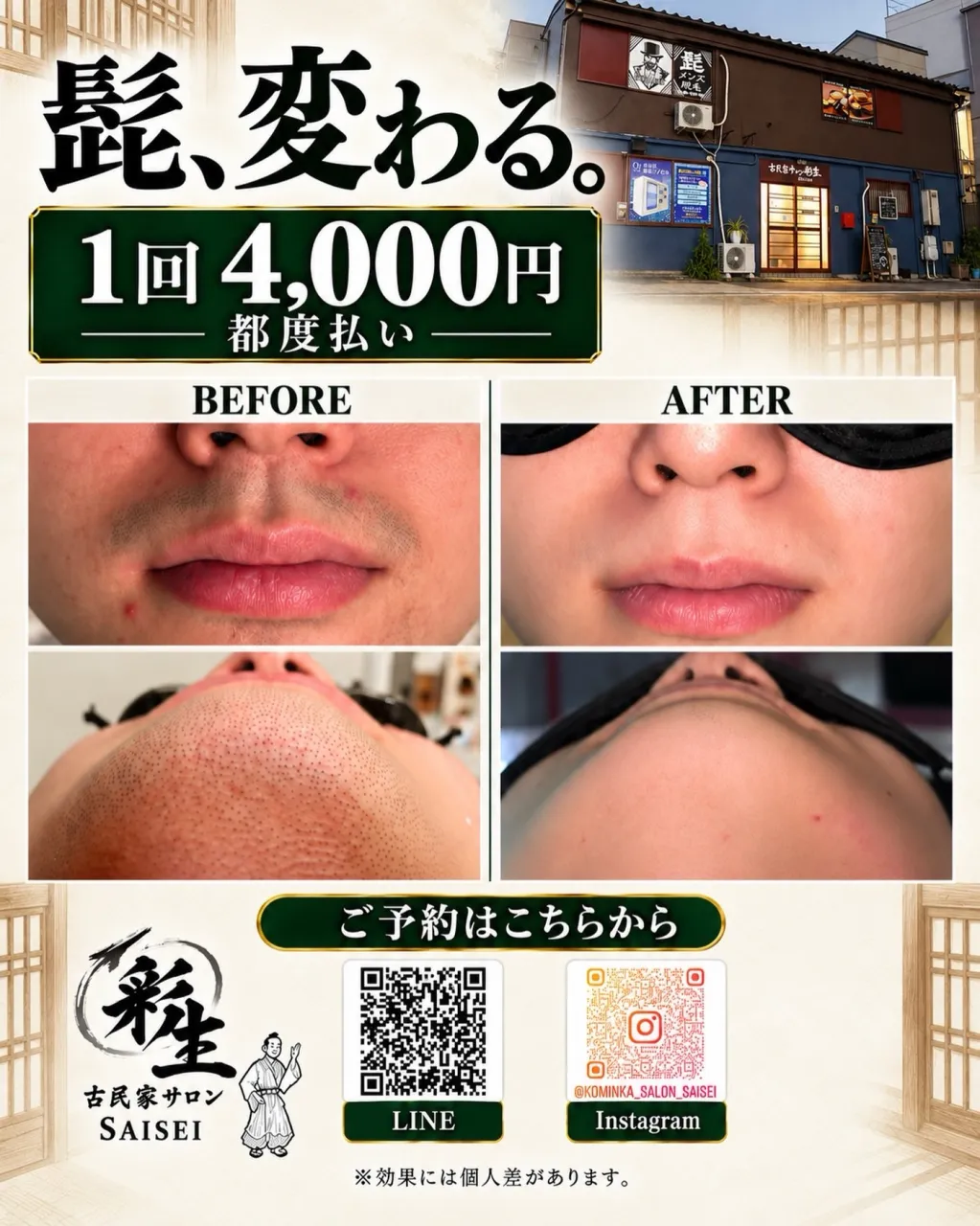 髭脱毛をお考えのあなた！