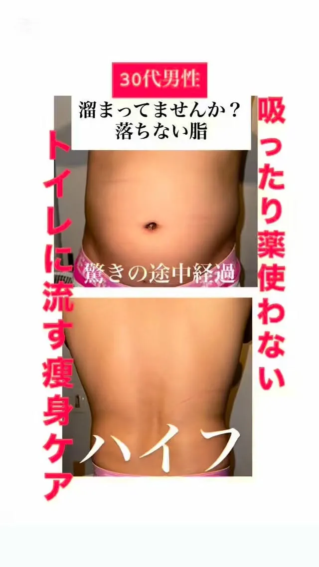 頑固な腹まわり、ハイフでリセット